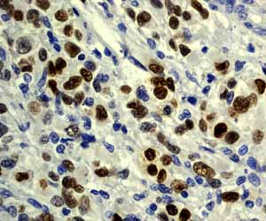 Immunohistochemistry (Formalin/PFA-fixed paraffin-embedded sections) - Anti-Mutant p53 [Y5] antibody (ab32049)