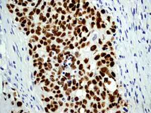 Immunohistochemistry (Formalin/PFA-fixed paraffin-embedded sections) - Anti-Mutant p53 [Y5] antibody (ab32049)