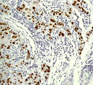 Immunohistochemistry (Formalin/PFA-fixed paraffin-embedded sections) - Anti-Mutant p53 [Y5] antibody (ab32049)