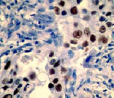 Immunohistochemistry (Formalin/PFA-fixed paraffin-embedded sections) - Anti-Mutant p53 antibody [Y5] (ab32049)