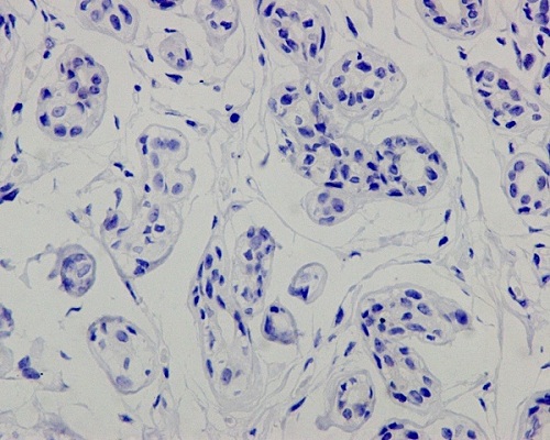 Immunohistochemistry (Paraffin-embedded sections) - Anti-Mutant p53 [Y5] antibody (ab32049)