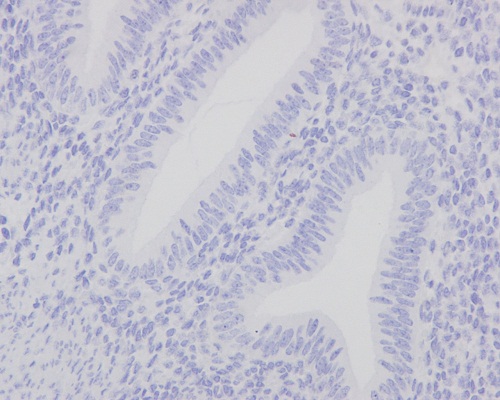 Immunohistochemistry (Formalin/PFA-fixed paraffin-embedded sections) - Anti-Mutant p53 [Y5] antibody (ab32049)